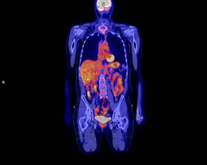 CT FDG normal
