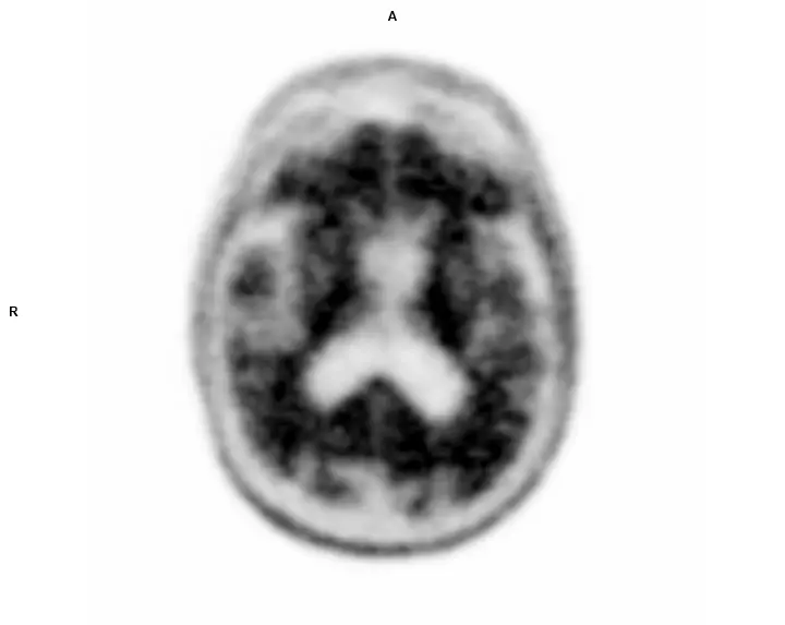 PET Brain abnormal