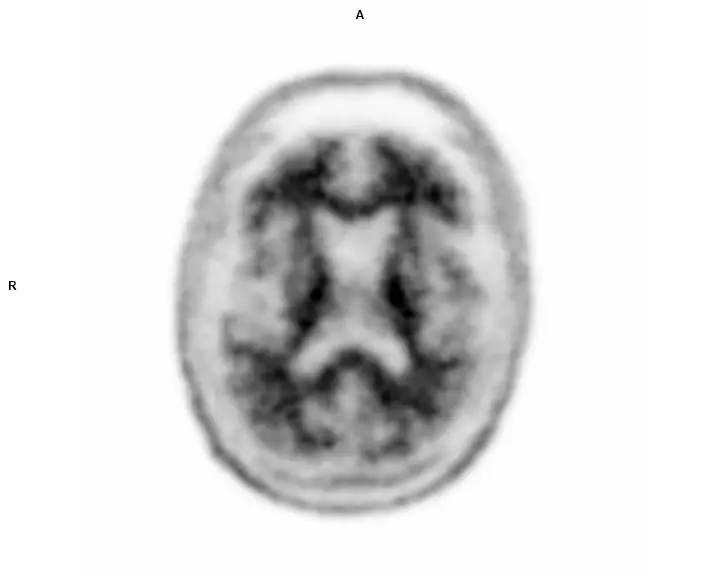 PET Brain normal
