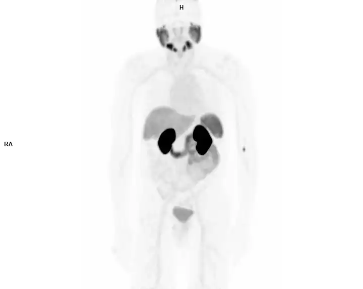 PET AC PSMA