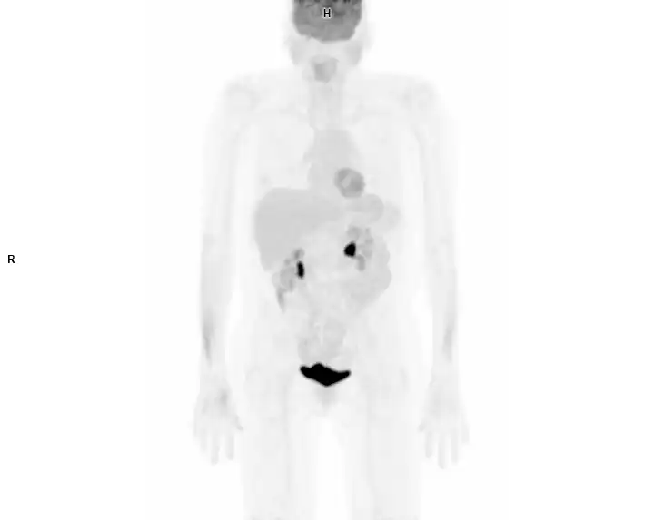 PET AC Normal